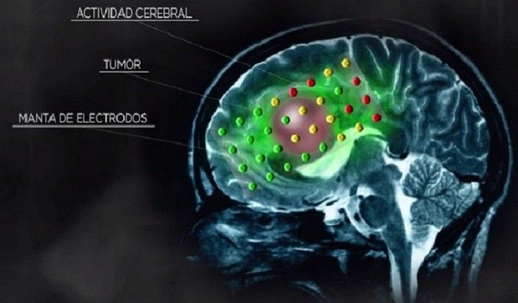diferentes enfermedades del cerebro