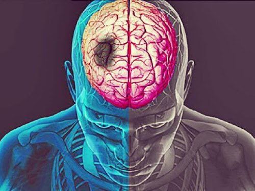 diferentes enfermedades del cerebro