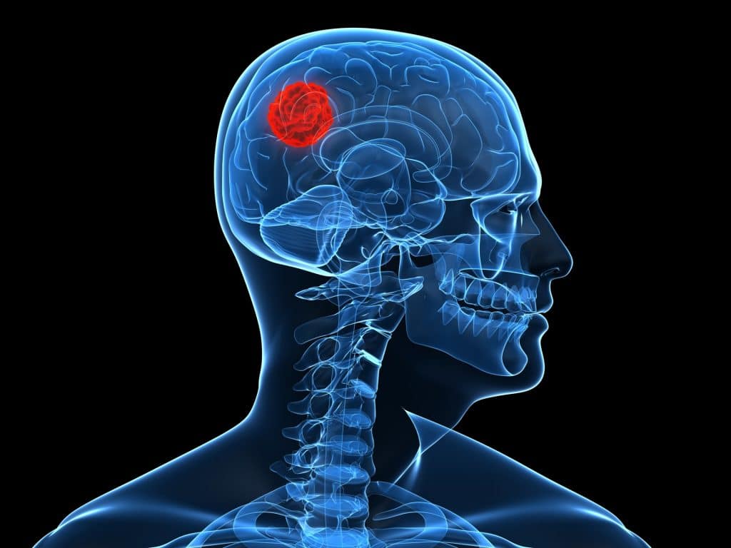 tratamiento del tumor en el cerebro