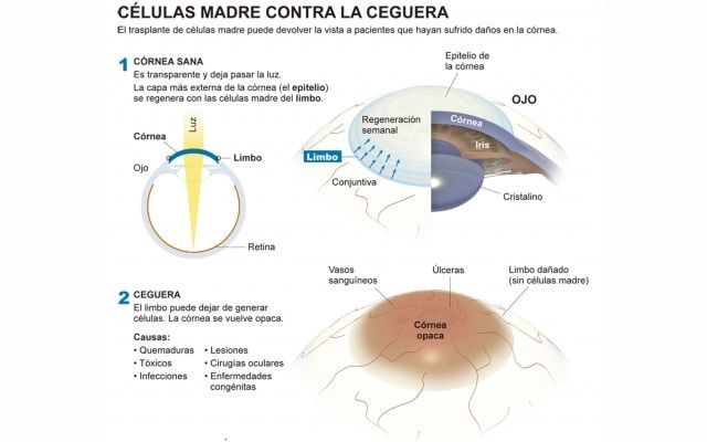 celuls madres como tratamiento para la ceguera y Stargardt