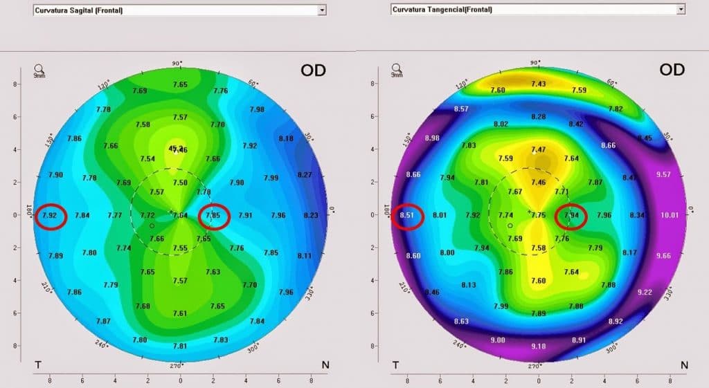 Mapa corneal para diagnosticar queratocono