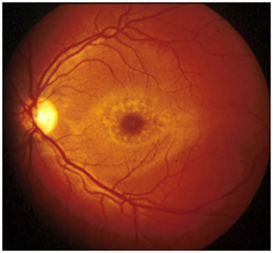 Distrofia retinal