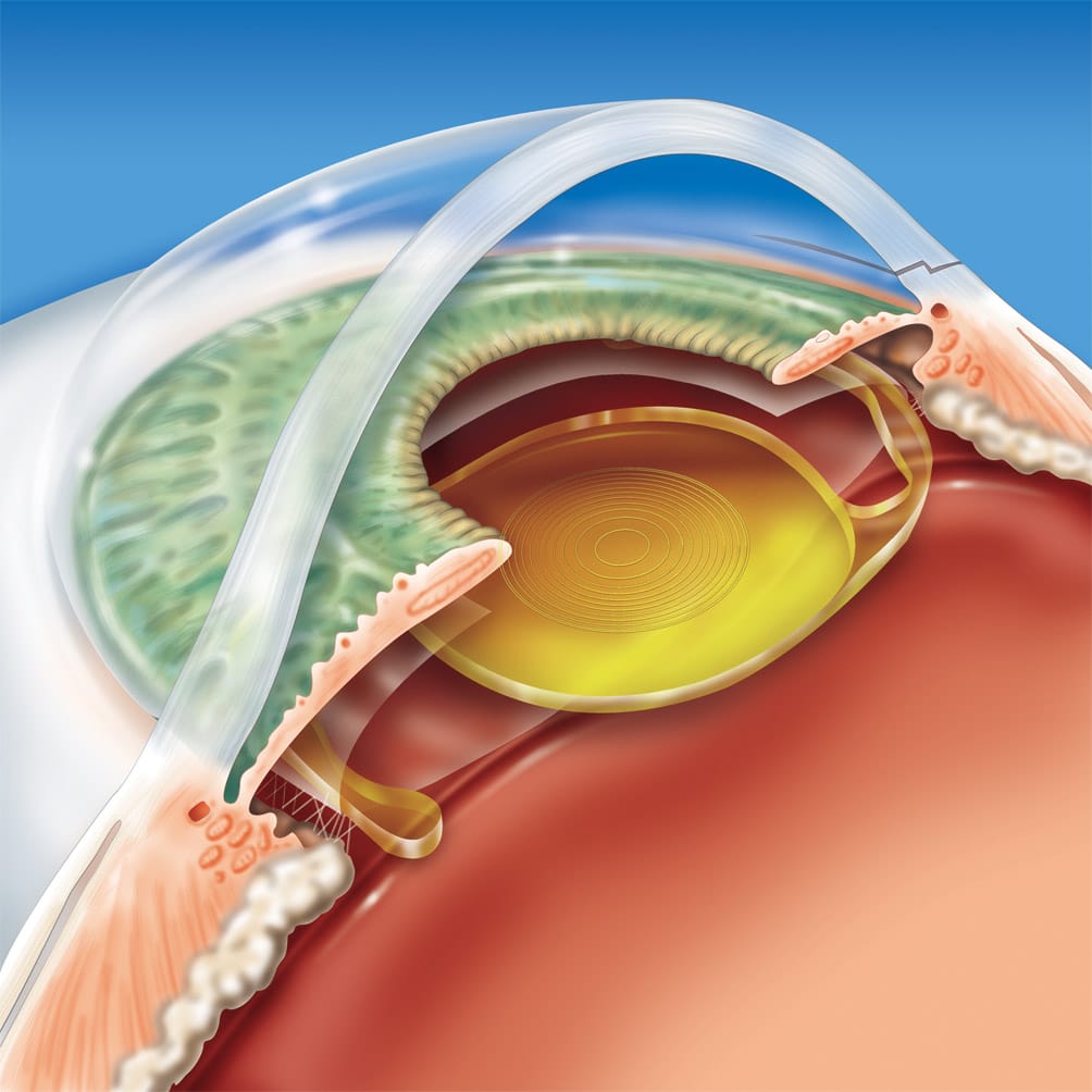 lente intraocular para afaquia