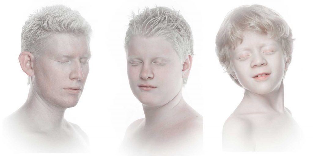 Fotofobia en Albinismo ocular