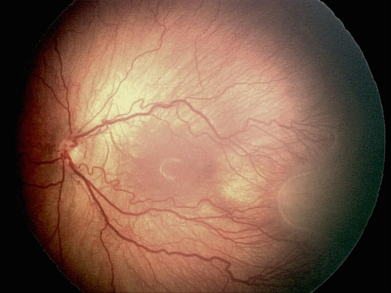 retinopatía del prematuro retina