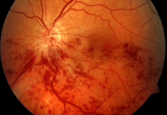 Causas de la retinopatia diabetica