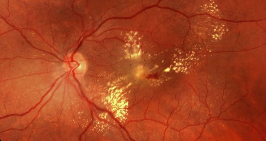 Causas de la retinopatia diabetcia
