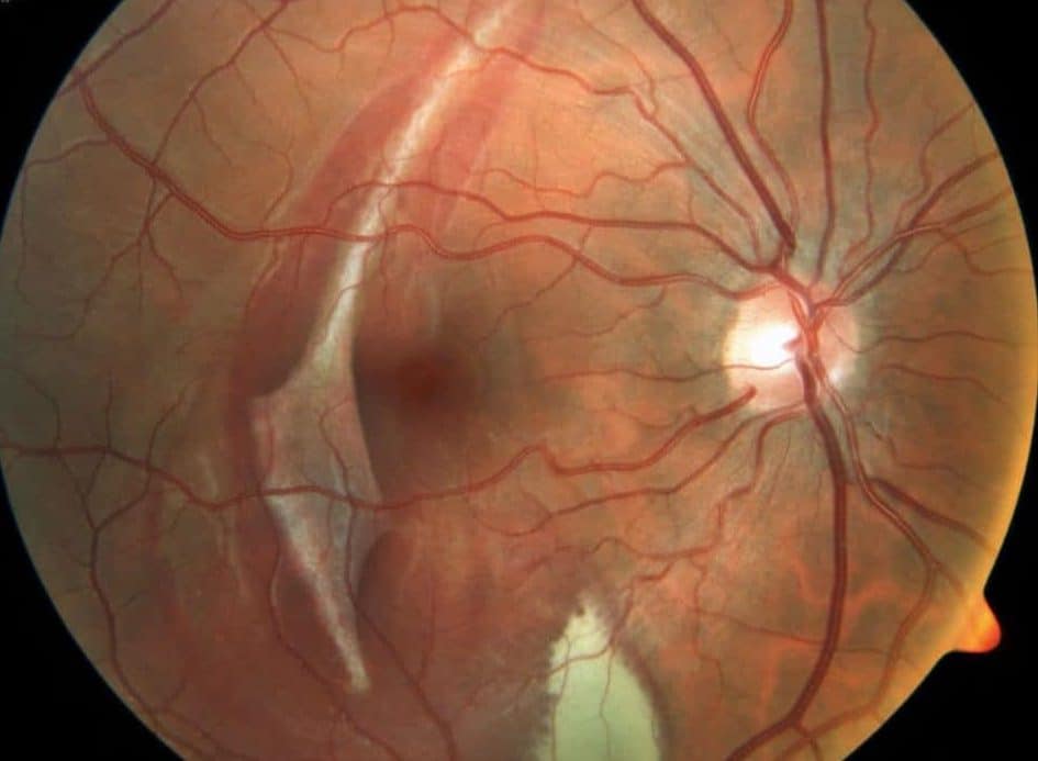 Causas de la retinopatia diabetica