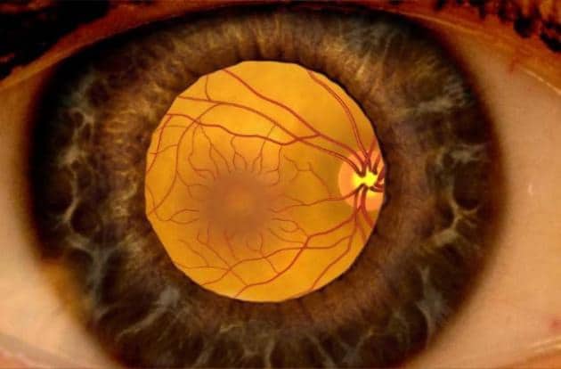 Causas de la retinopatia diabetia