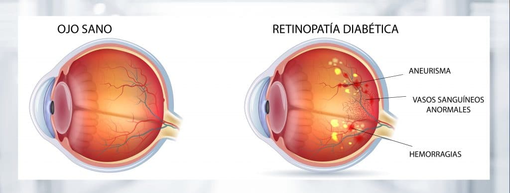 ojo con retinopatia diabetica