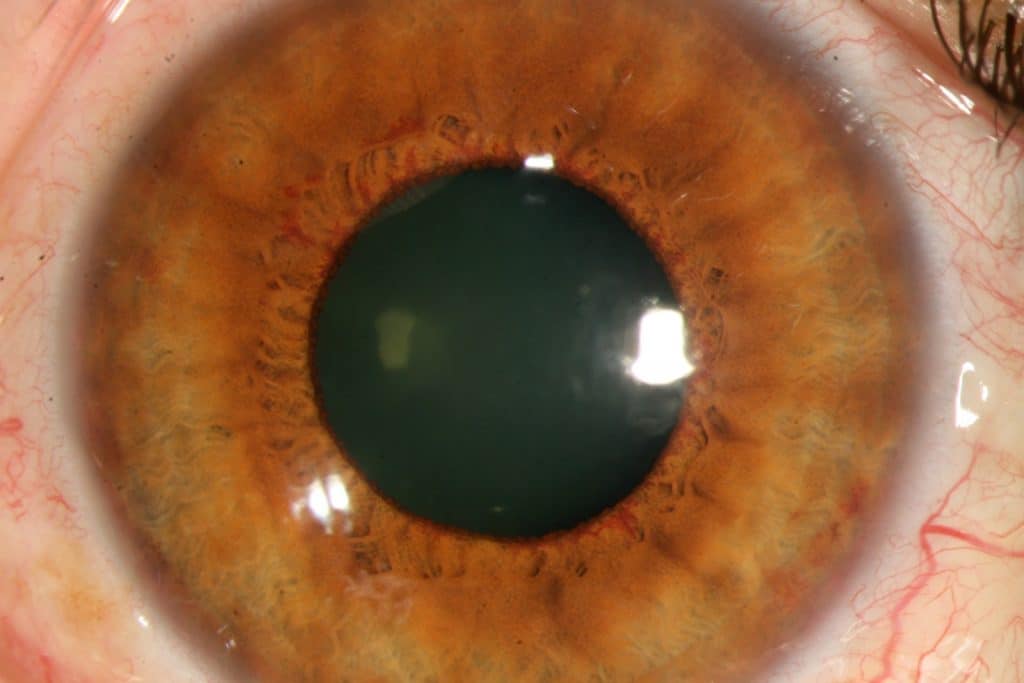glaucoma neovascular por retinopatia