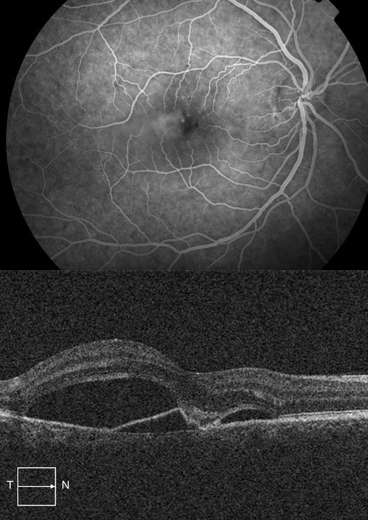 examen diagnostico de retinopatia