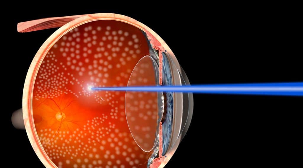 vitrectomia de retinopatia