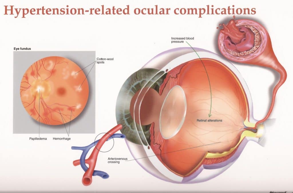 2da clasificacion de la retinopatia hipertensiva