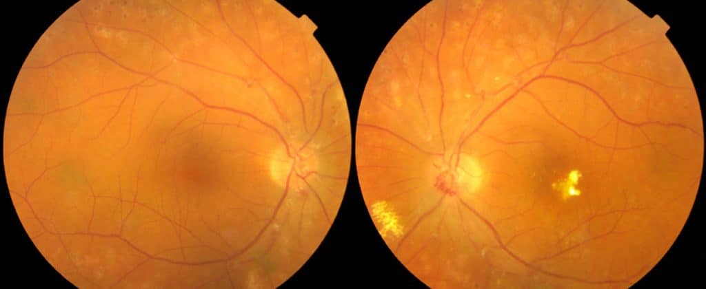 retinopatia con exudados lipidicos