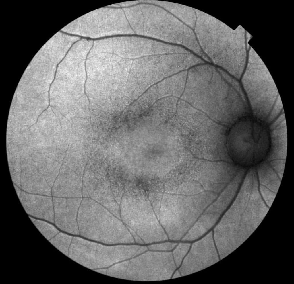 retinosquisis, tipo de retinopatia