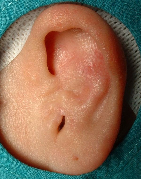 Artresia del conducto auditivo externo