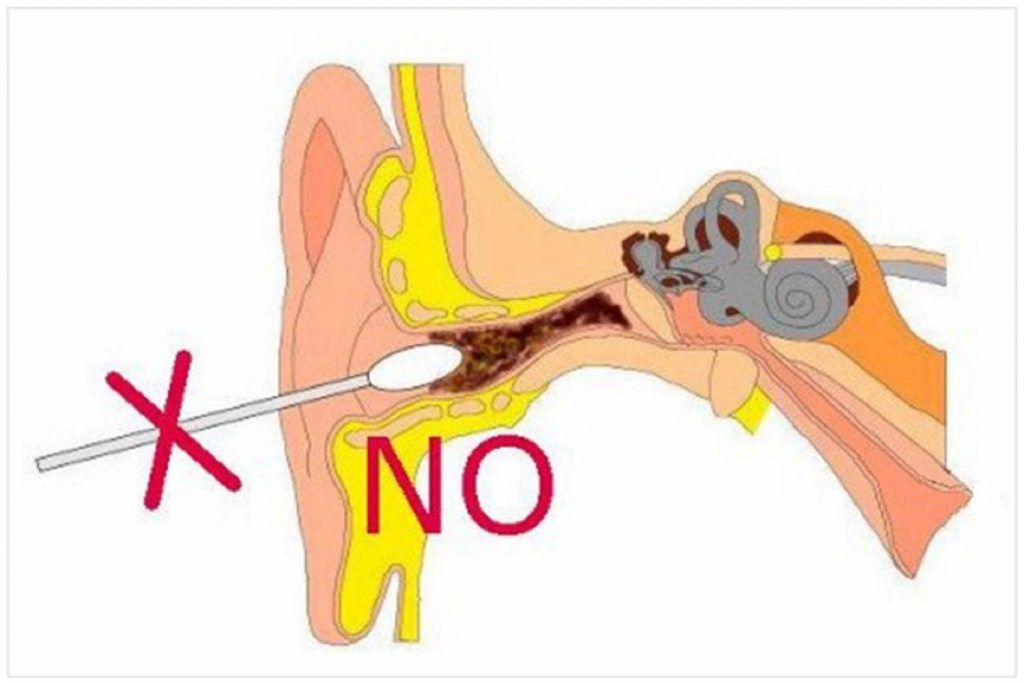 forma incorrecta de limpiar la cera de oído