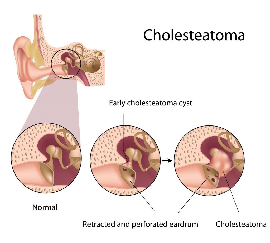 mastoidectomia por colesteatoma
