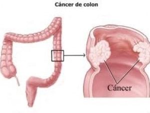 cancer de colon definicion