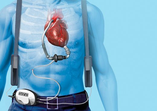 dispositivo de asistencia ventricular